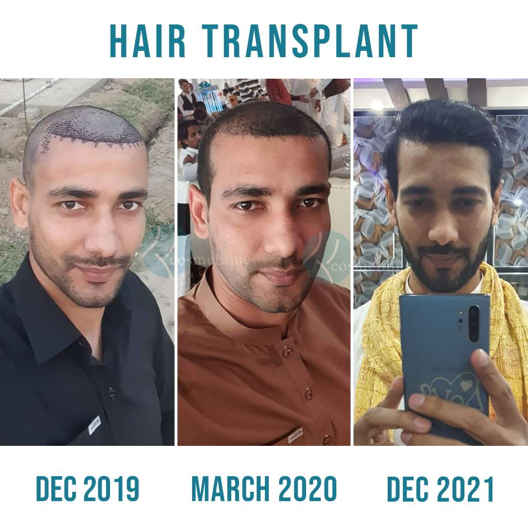 3-Hair-Transplant
